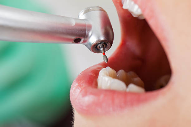 Best Emergency Dentist for Lost Fillings or Crowns in Cherry Hill, VA